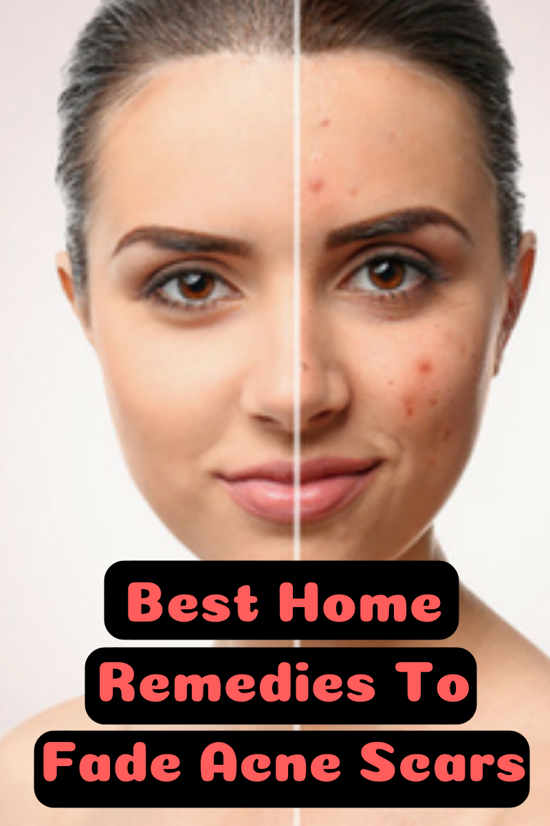 How To Fade Acne Scars Fast Naturally