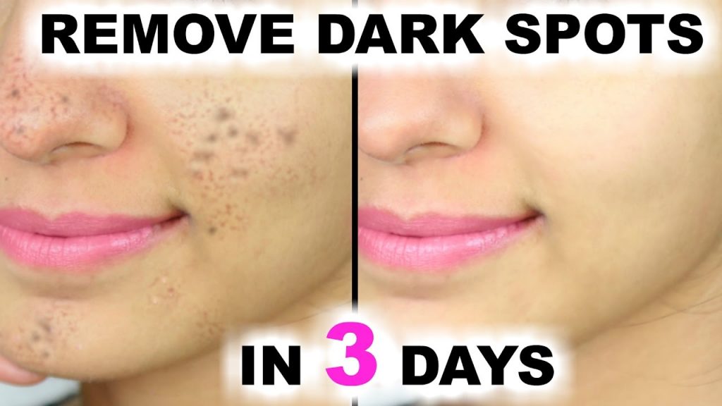 Most Effective Remedies For Dark Spots Removal