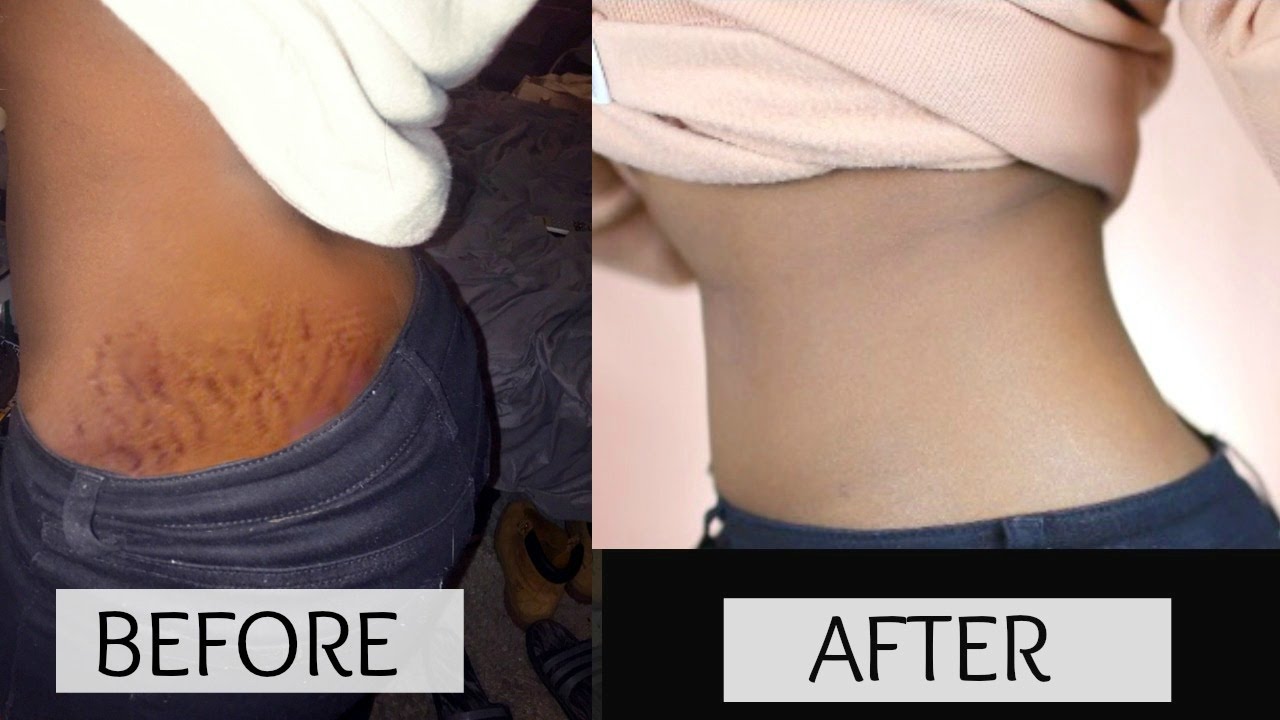 Fast Stretch Marks Removal Remedies