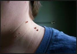 How To Get Rid Of Skin Tags